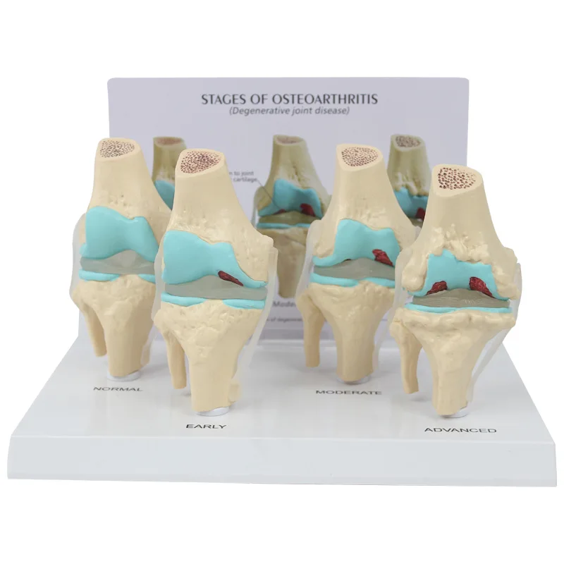 Medical Science Teaching Aids Stage 4 Knee Joint Model with Back Card Orthopedic Teaching Display Aids