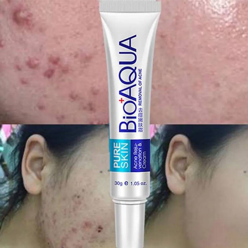 Effective Acne Removal Cream Acne Treatment Fade Acne Spots Oil Control