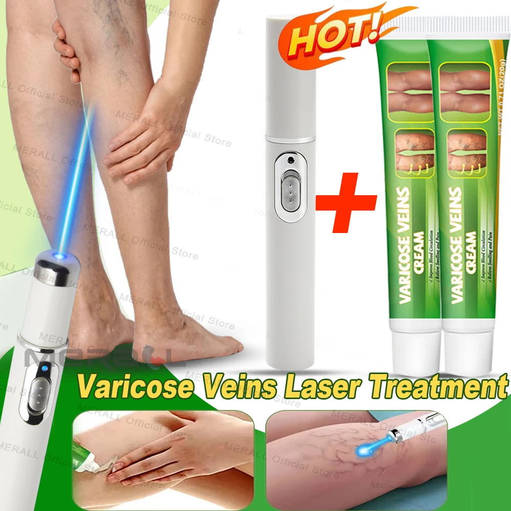 Varicose Veins Laser Treatment Cream Effective Relieve Legs Dilated Vasculitis Phlebitis Natural Formula Ointment Varicose Veins