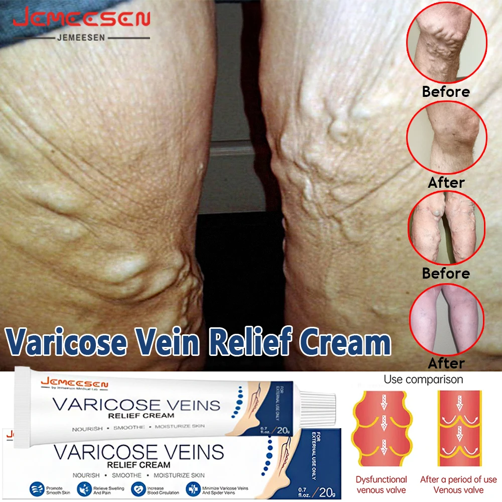 Jemeesen Varicose Veins Relief Cream Leg Vasculitis Phlebitis Spider