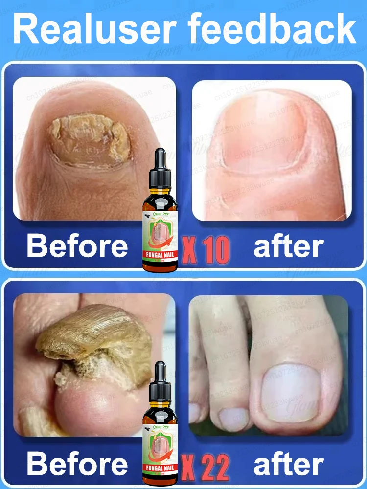 Fungal Nail Repair Fast OnychomycosisFungus Nails