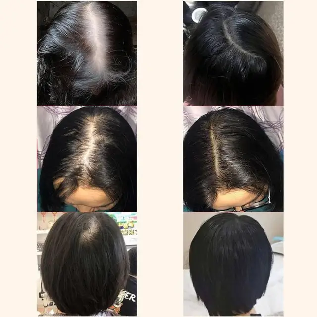 Aceite Esencial de jengibre para el crecimiento del cabello, líquido Anti  pérdida de cabello, calvicie, remedio, crecimiento más grueso, cuidado del  cabello, tratamiento del cuero cabelludo, 2022 - AliExpress