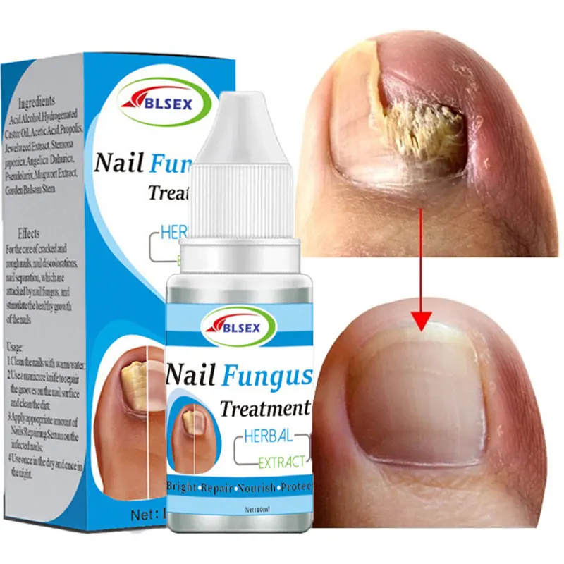 

Fungal Removal Liquid Repair Onychomycosis Paronychia Fingernails Treatment Fungus Nails Anti Infection Toe Nail Toenails