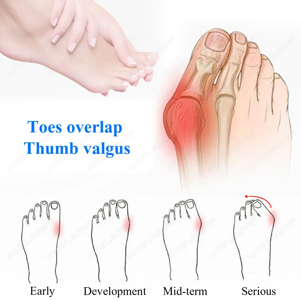 Toe Pads Toe Protective Toes Separator Silicone Bunion Hallux Valgus Toe Overlap Corrector Soft Gel Straightener Spacers Stretchers Care