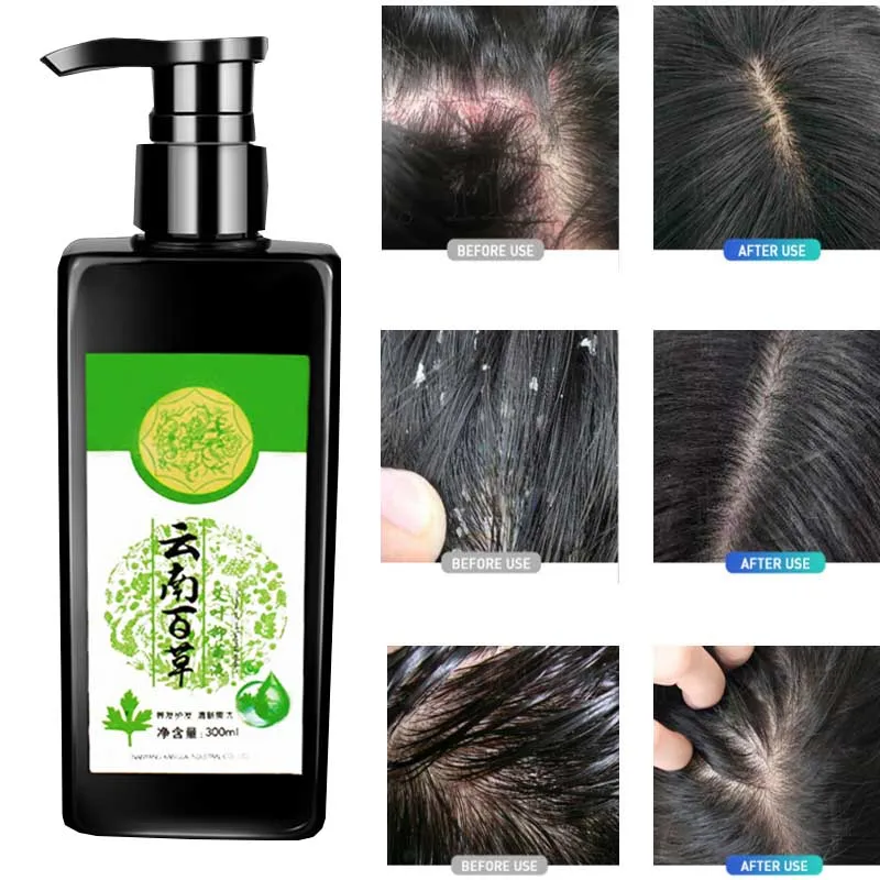 300ml Shampoo Hair Care Relieve Scalp Folliculitis Dandruff Itching Oil Control Remove Mites Seborrheic Scalp Pustules hair scrubber handheld massager shampoo brush shower bath exfoliate remove dandruff promote hair grow therapy comb health care