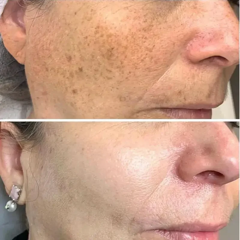 O açafrão que alvejante o soro facial, sardas, remove pontos escuros, melasma ilumina, melanina, cicatriz da acne, antienvelhecimento, firme ilumina