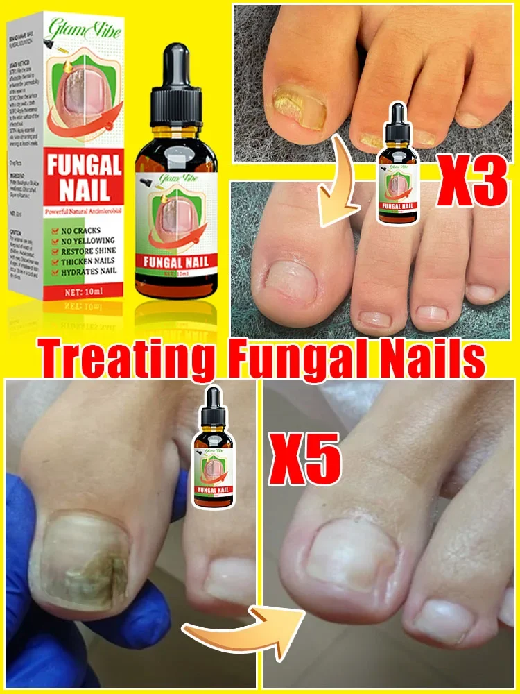 Eliminate nail fungus and say goodbye to onychomycosis. fungus solution