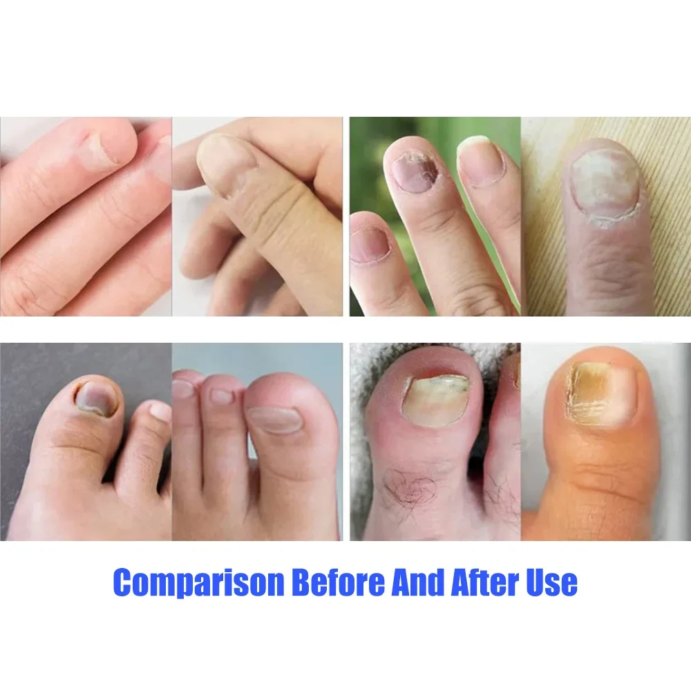 Nail Fungus Remover Laser Therapy Pen Nail fungus laser treatment device nail fungus cleaning device Laser treatment for foot nail Repair Onychomycosis Remove