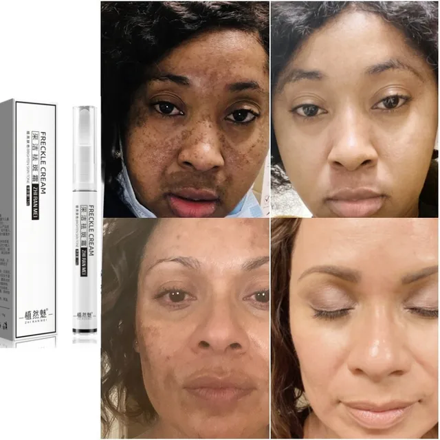 Crème blanchissante puissante pour taches de rousseur, élimine les taches foncées, les marques d'acné, estompe le mélasma, éclaircit la mélanine, hydrate, soin pour le visage, 10 pièces