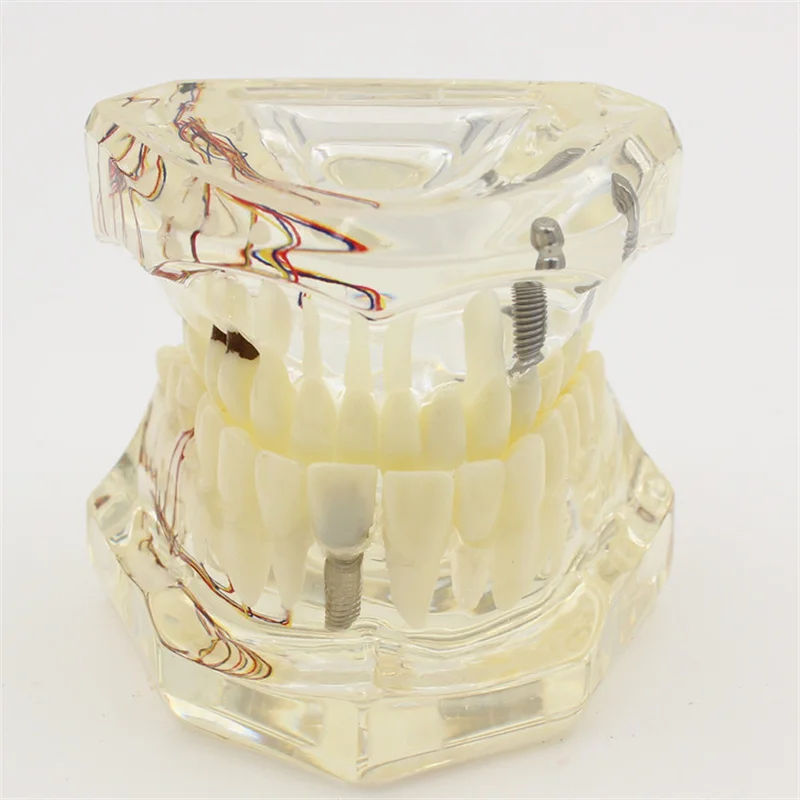 

1pcs Dental Teaching Teeth Model with Nerve Implanted Transparent Pathological Repair Teaching Demonstration model Dentistry