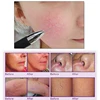 High Frequency Spider Veins Removal Device Remove Facial Thread Veins Red Blood Vessel Spots Vascular Removal Beauty Equipment 6
