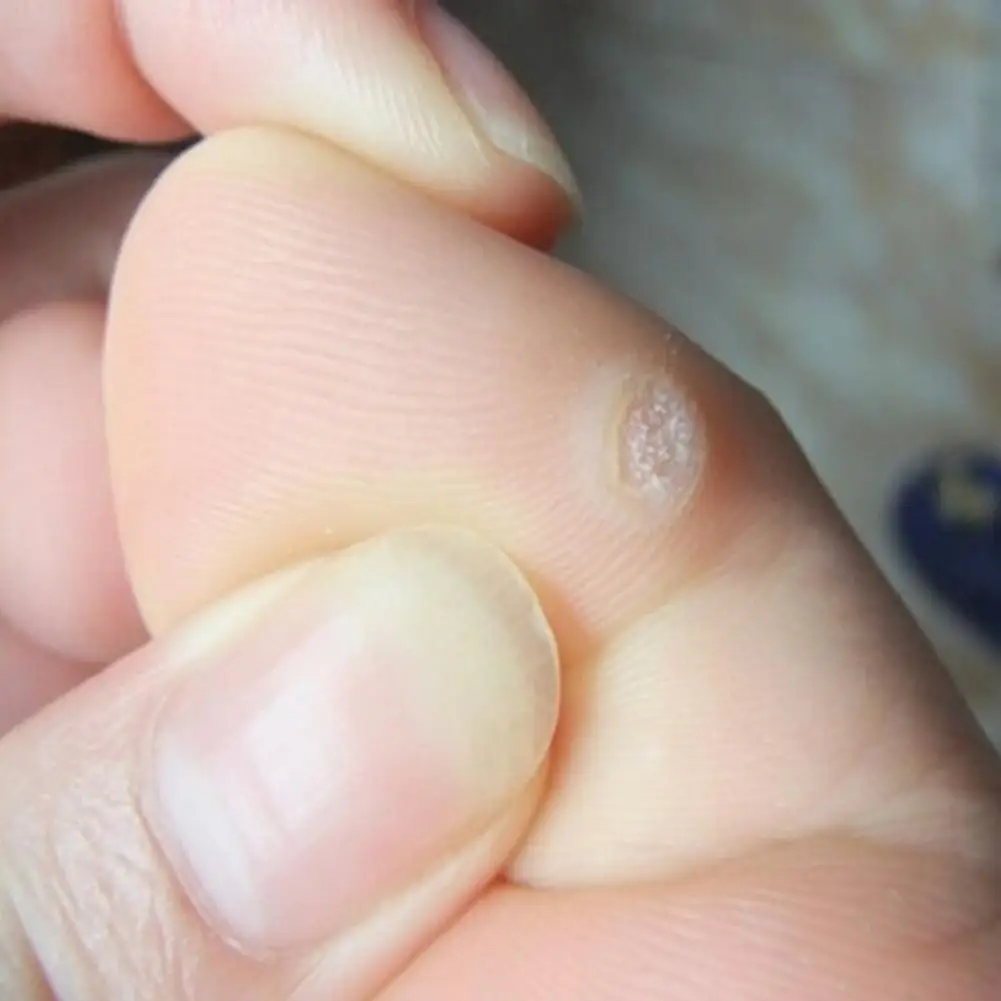 Foot Corn Remover Stickers 6PCS Foot Corn Remover Stickers Painless Medical Plaster Warts Thorn Feet Callus Chicken Eye Treatment Sticker Feet Care