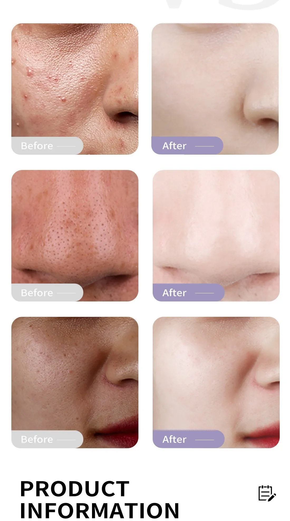 Κρέμα καθαρισμού προσώπου Λεύκανση και αποκατάσταση ακμής Λεύκανση δέρματος Φροντίδα προσώπου Απολέπιση Απομάκρυνση λαδιού Περιποίηση δέρματος για εφήβους Ομορφιά_voghion.com