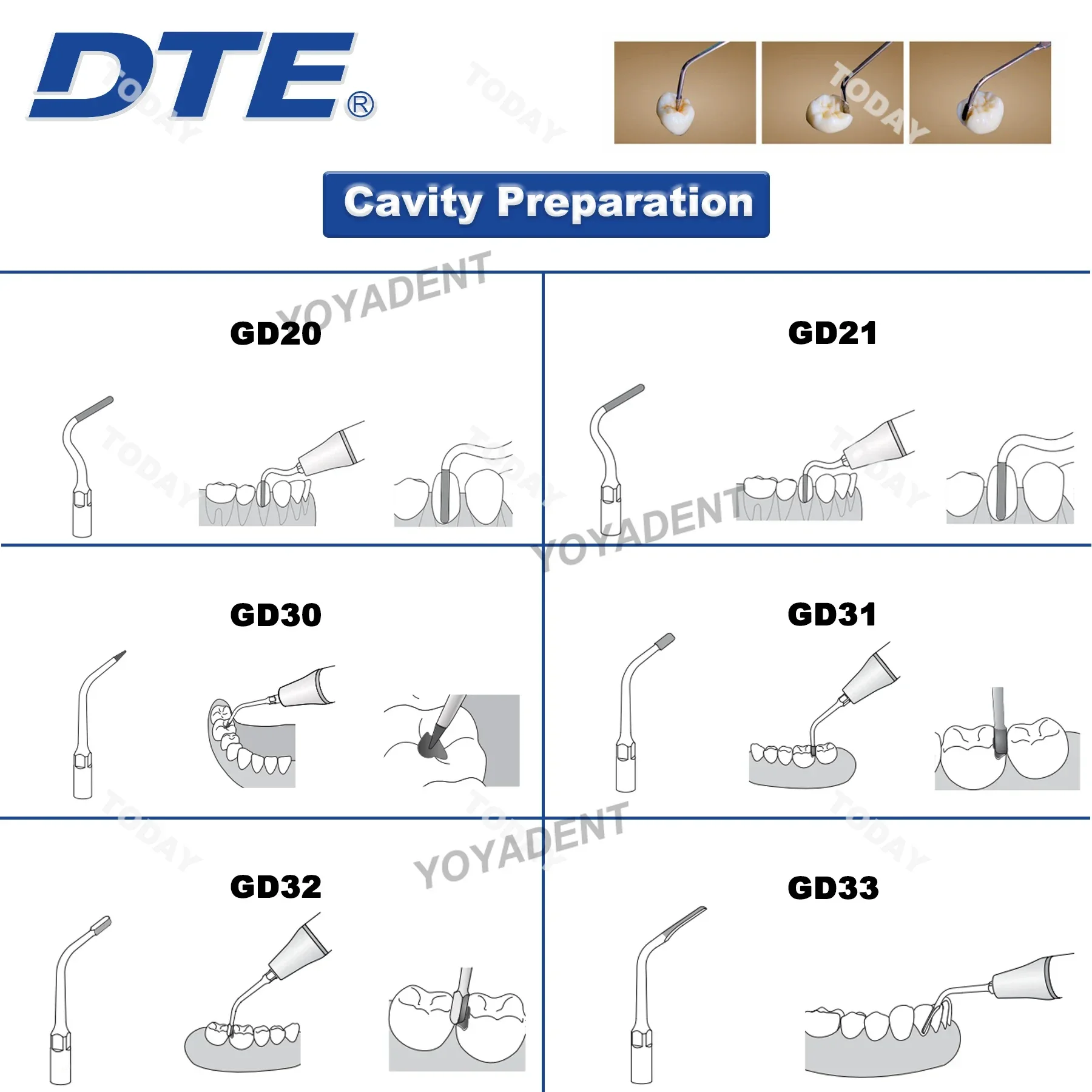Woodpecker DTE Dental Ultrasonic Scaler Tips Periodontics Endodontics Scaling Tips Fit NSK SATELEC Scaler Handpiece Dental Tools 3