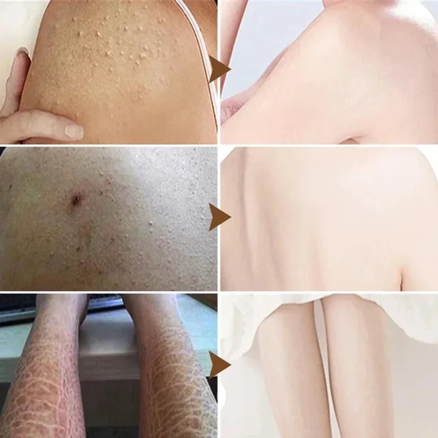 Keratosis Pilaris Cream – Smooth & Clear Skin