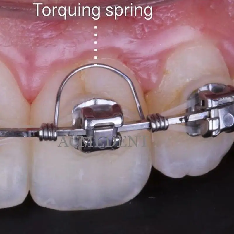 歯列矯正 バネの実際の使い方と選択基準：50個セットのトーキング