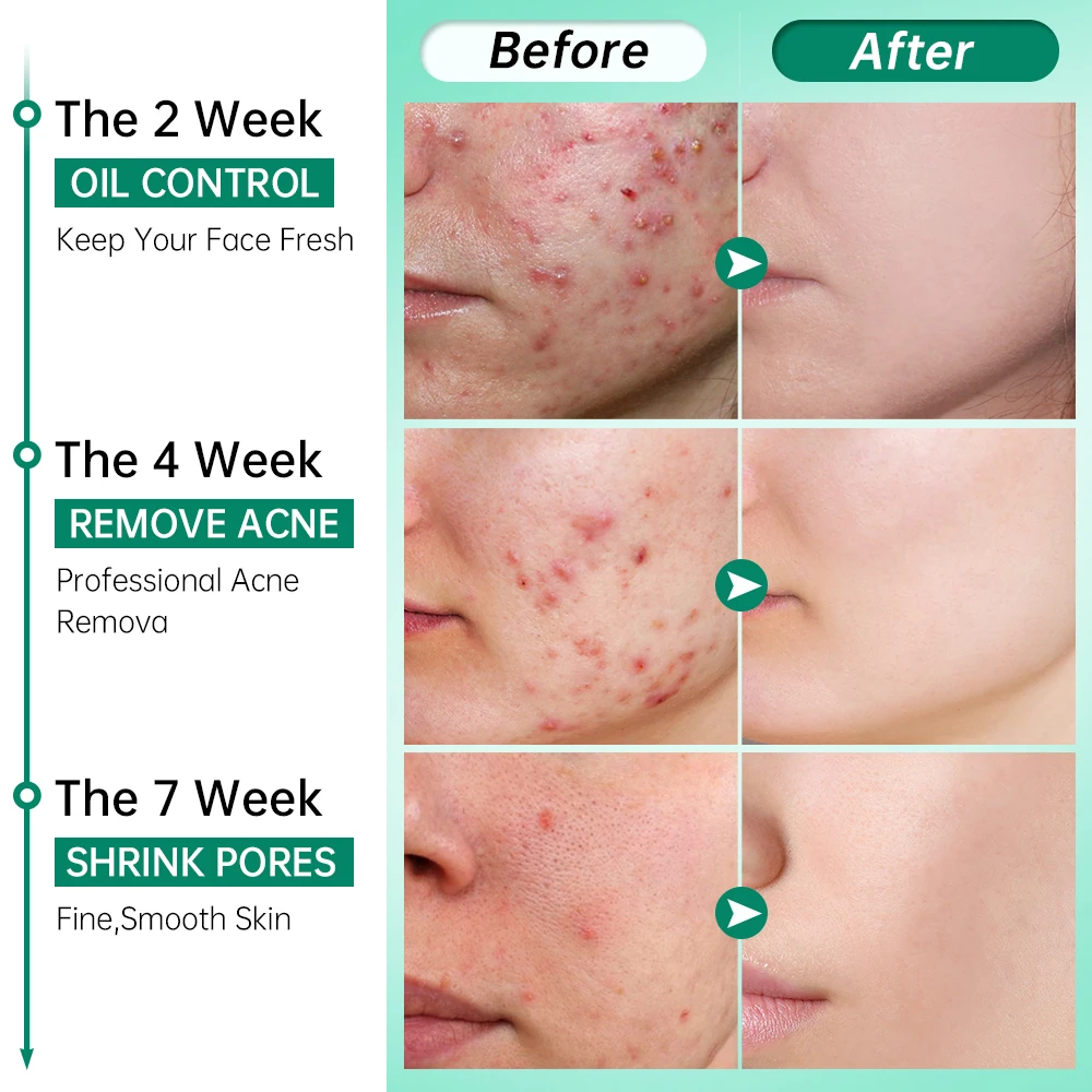 Acne Face Cream Pimple Scars Removal Shrink Pore Oil Control Hyaluronic  Acid Smoothing Acne Treatment Facial Creams Skin Care - AliExpress