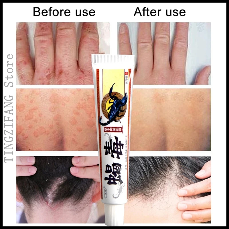 

10Pcs Scorpion Poison Antibacterial Cream Ointment Skin Care Dermatitis Eczema Pruritus Psoriasis Cream Skin Care18g without box