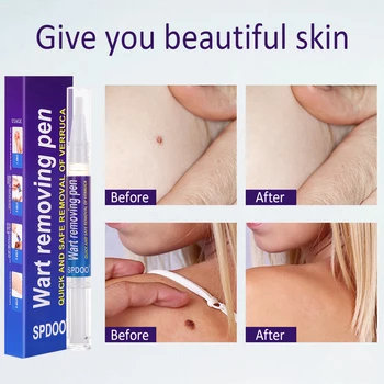 Removing Against Moles Remover Anti Verruca Remedy Liquid Pen Treatment Papillomas Removal Of Warts Liquid From Skin Tags 4