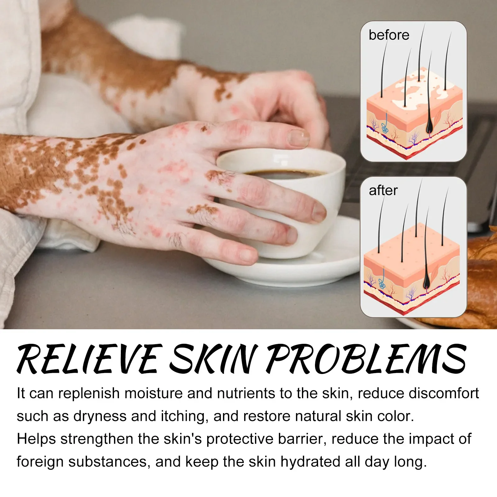 Spray anti-Vitiligo, élimine les taches blanches de la teigne, élimine les taches de sueur, traitement de la leucoplasie, répare, hydrate la peau, liquide de soin_voghion.com