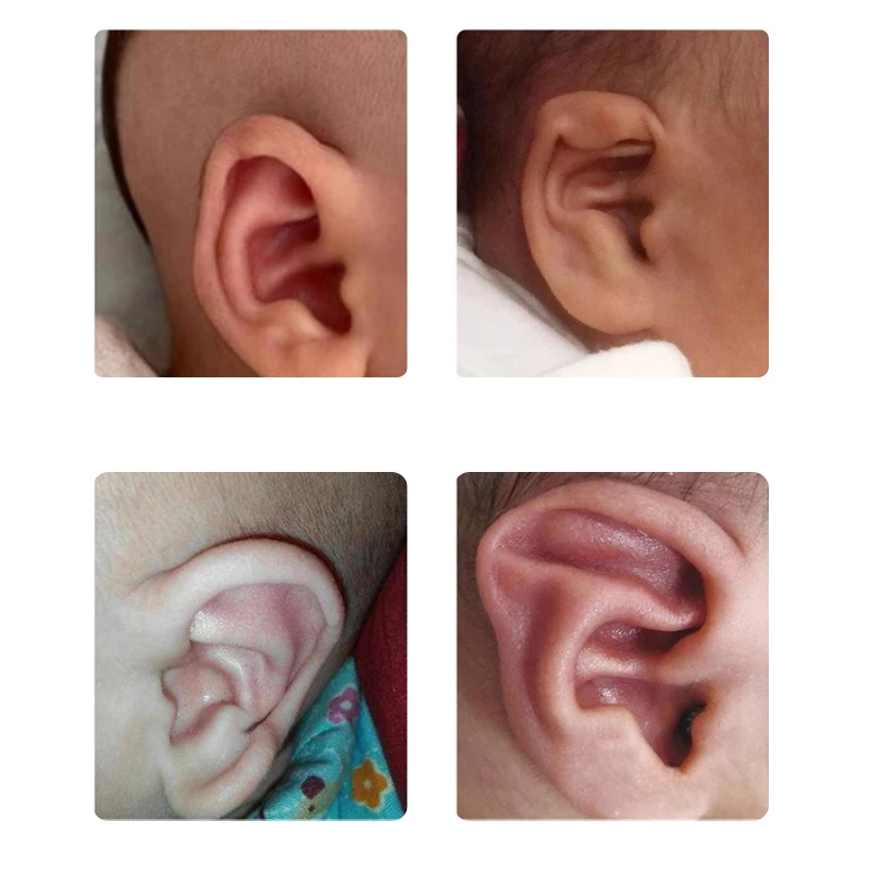 Pansements Correcteurs D'oreille Pour Bébé - Silicone Doux, Adhésif Fort, Pour Oreilles Décollées Et Légères Déformations, Sans Effets Secondaires
