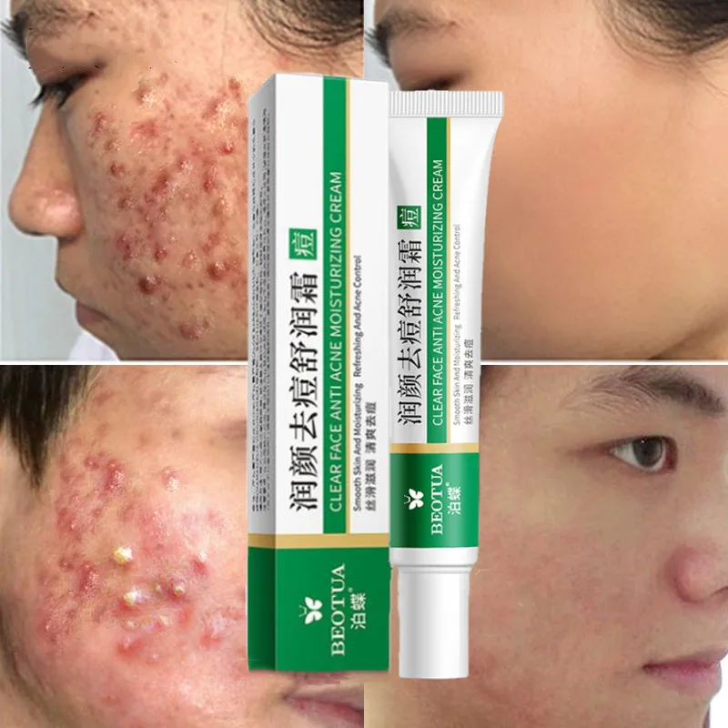 Effective Acne Removal Cream Treatment Scar Spots Control Shrink Pores Whitening Moisturizing Anti-Acne Face Gel Care | Красота и