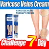 Ointment for Varicose Veins Eliminate Vasculitis Phlebitis to Relieve Spider Leg Pain Treatment Herbal cream 1