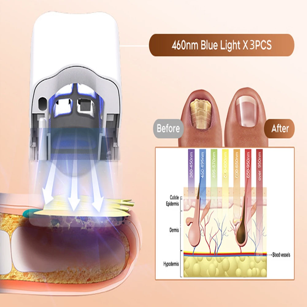 Repair Nail Fungus Laser Treatment Device Nail Fungal Essential Oil Toenail Fingernail Onychomycosis Serum Toe Cure Effectively nail fungus remover laser therapy pen