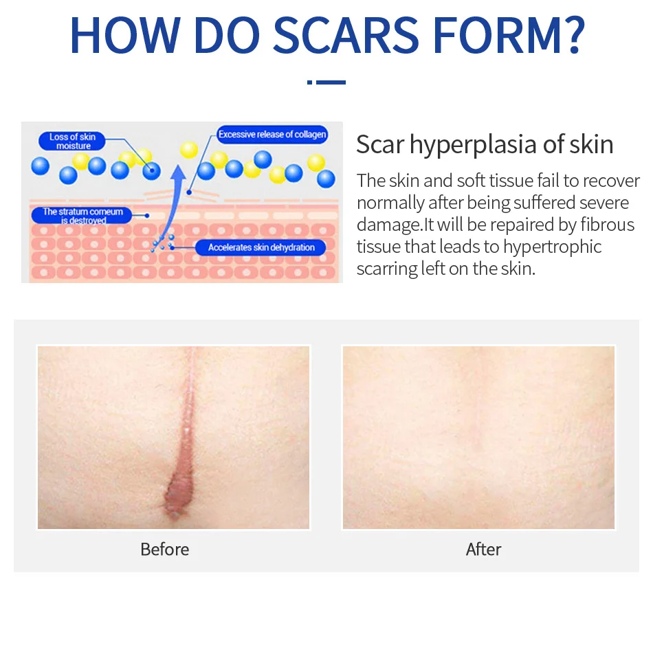 3/5/10PCS Scar Removal Cream Gel Remove Acne Spots Treatment Stretch Marks Burn Surgical Scar Repair Cream Smoothing Skin Beauty