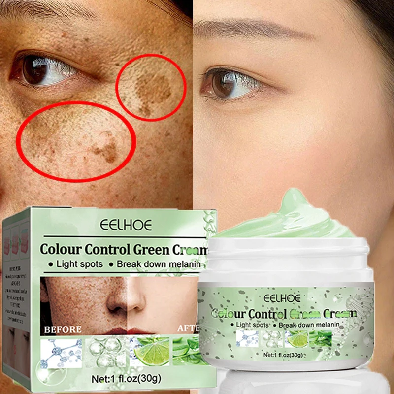 Whitening Freckle Cream Gel Remove Melasma Acne Spot Pigment Melanin Dark Spots Pigmentation
