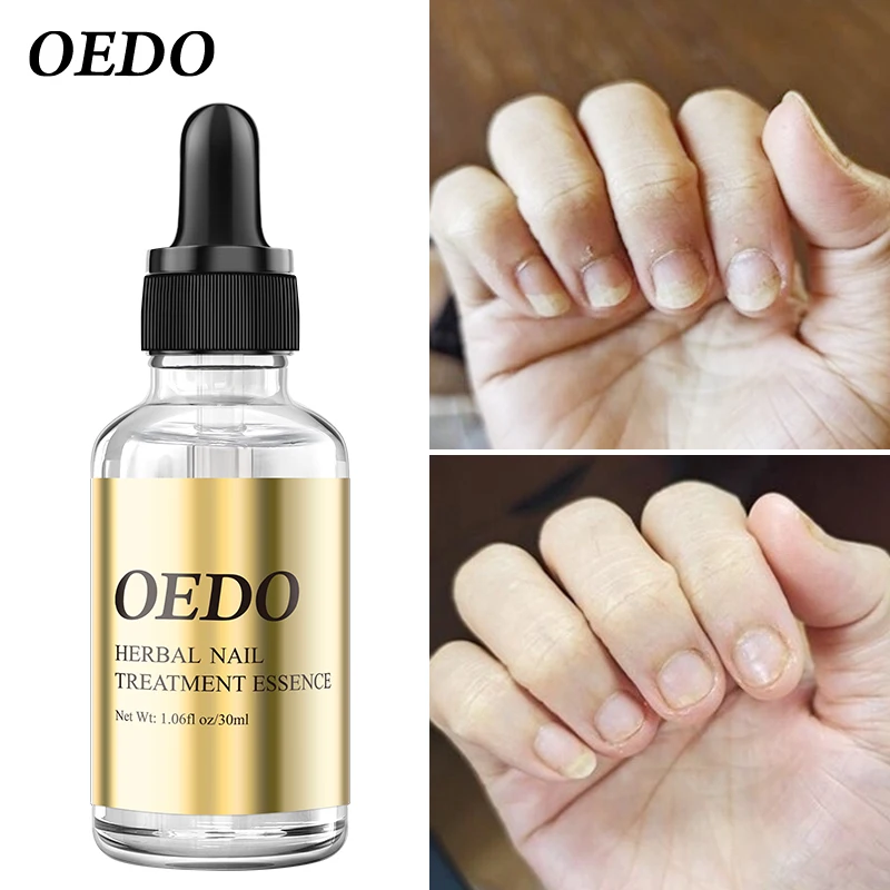 oedo nail fungus treatment