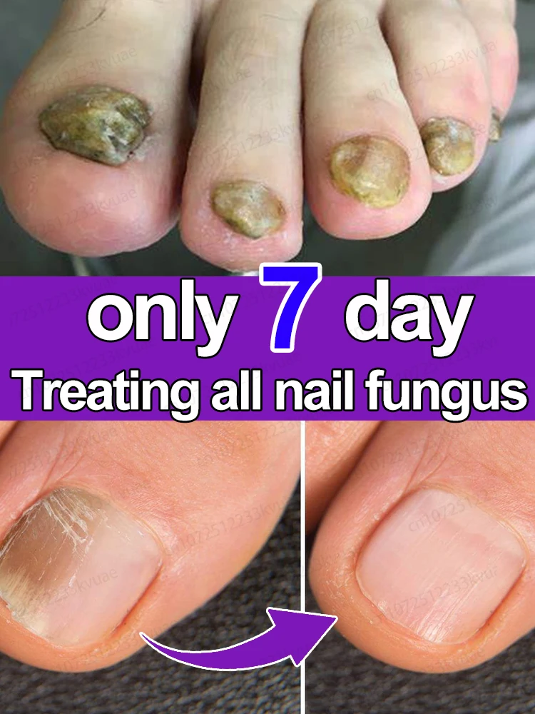 Nail fungus treatment essential oil repair onychomycosis in 7 days fungus solution organic essential oil