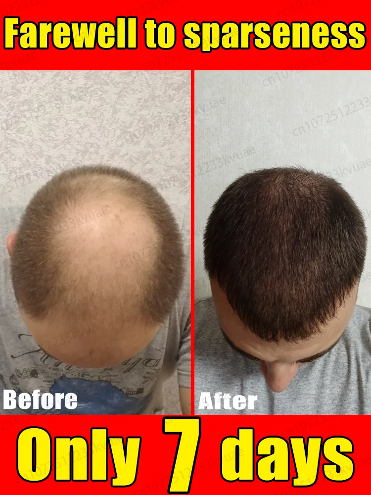 Designed specifically for those suffering from hair loss，No Add chemical stimulation