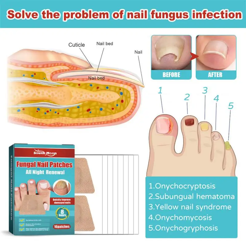Nail Care Nail Fungal Treatment Patch Anti Infection Feet Cuticle