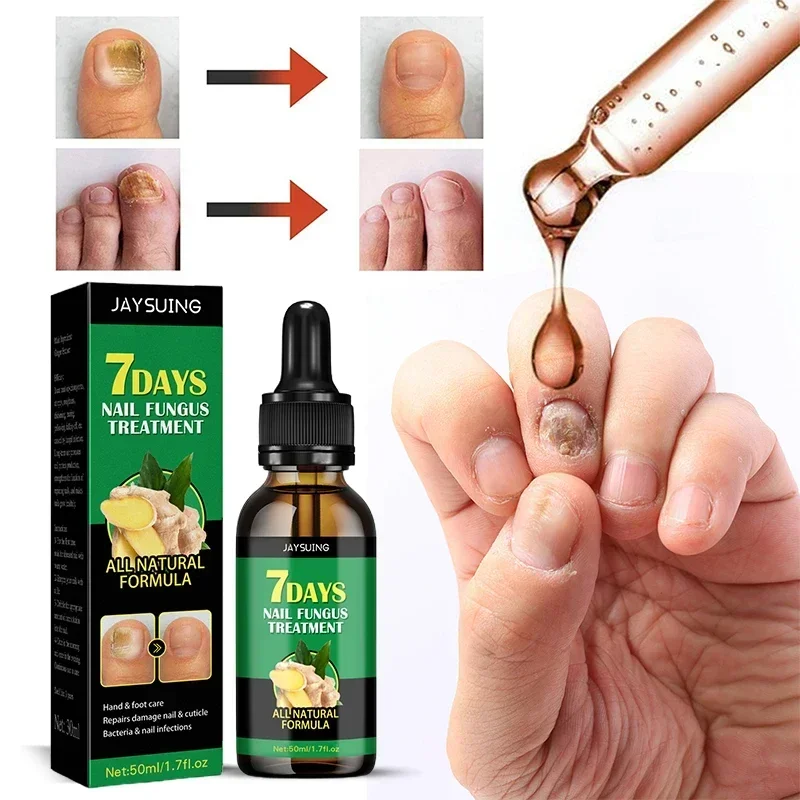 7 Days Nail Fungal Treatment Essence Oil Foot Toe Nail Fungus Removal Serum Repair Onychomycosi Anti Infection Gel Care Products nail fungus remover
