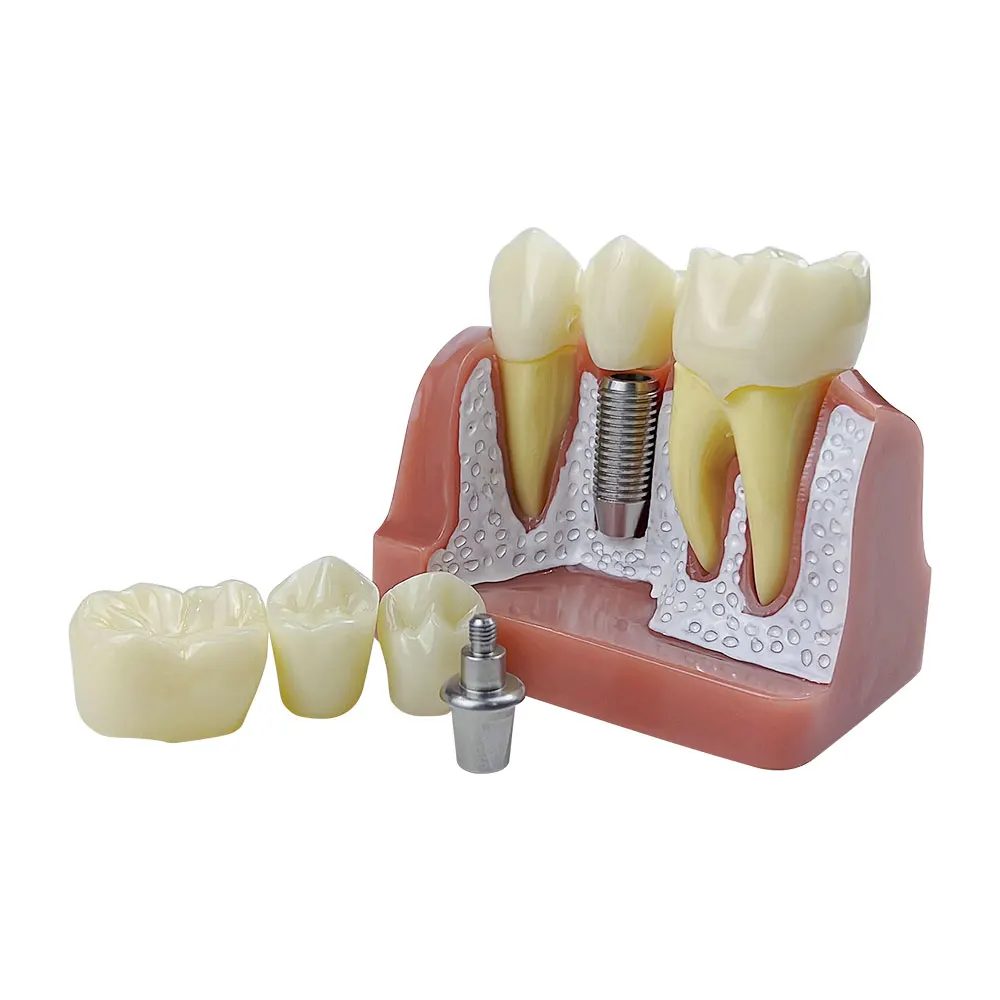 Modèle De Dents Implantées 4 Fois Pour Dentiste, Module De