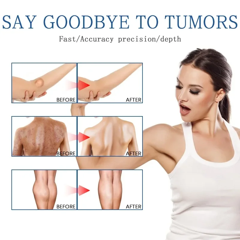Lipoma Removal Medicines Spray Fibroma Cellulite Remover Apply To Subcutaneous Lumps Fat Mass Treatment Skin Swelling Cream cream lumps remover
