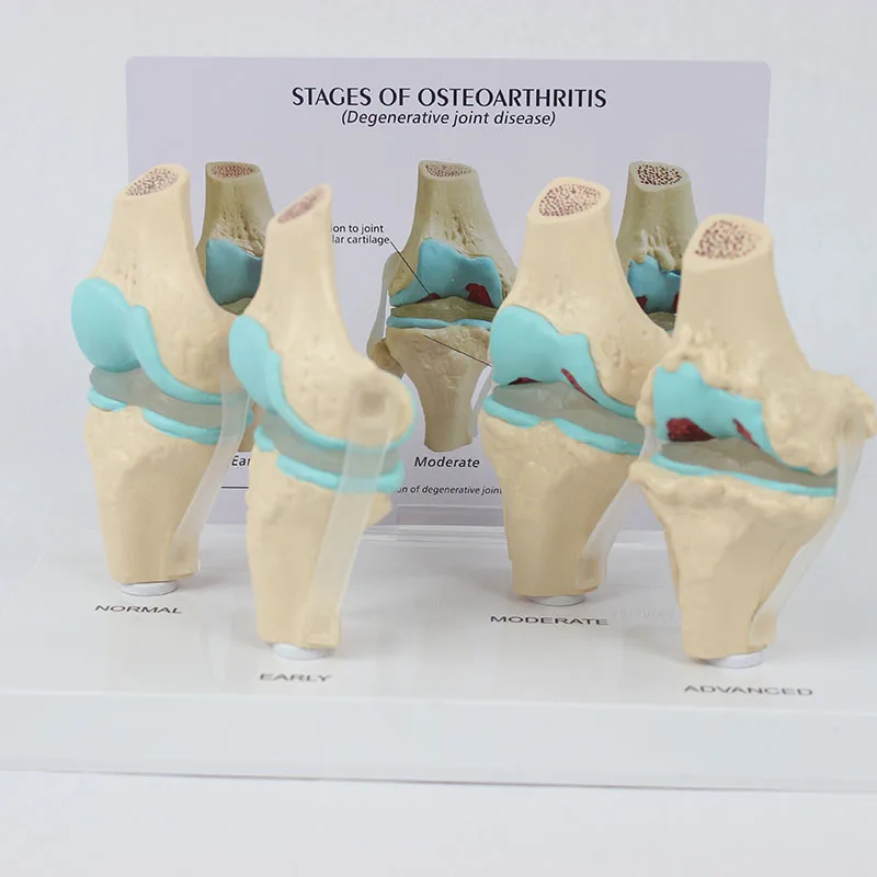 Medical Science Teaching Aids Stage 4 Knee Joint Model with Back Card Orthopedic Teaching Display Aids