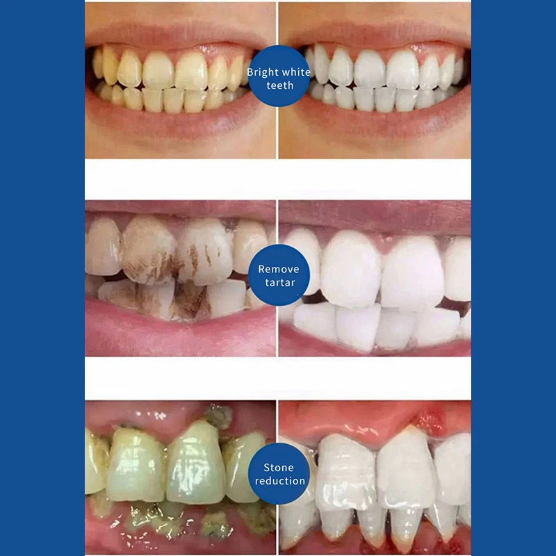 New Upgrade Quick Repair of Cavities Caries Removal of Plaque Stains Decay Whitening Yellowing Repair Teeth Teeth Whitening 4