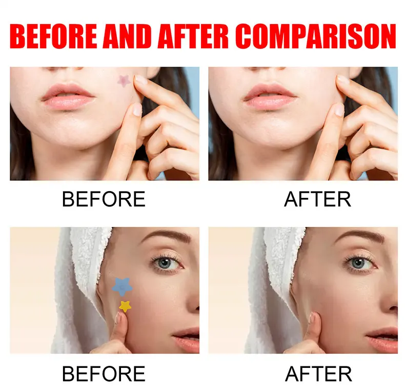 Repair Acne Patch - Image 8
