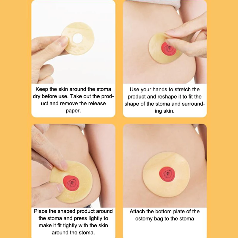 Anti-Leakage Ring 10Pcs For Colostomy Bag Ostomy Paste Ring Baseplates Stoma Care Products To Protect Skin