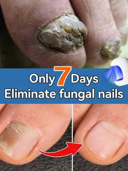 Laser Product For Nail Problems 1