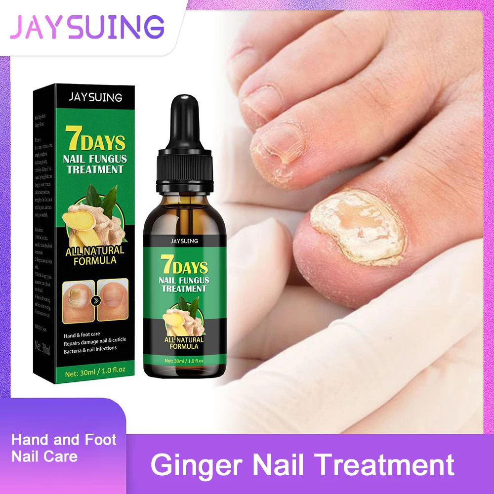 30ml Ginger Nail Fungal Treatment Hand Foot Care Essence Paronychia