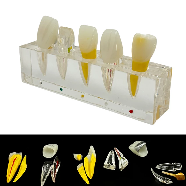 Dental Pulp Restoration Pathological Model Detachable Teeth Dissecting Premolar Teeth Cavity Filling Dentist Material