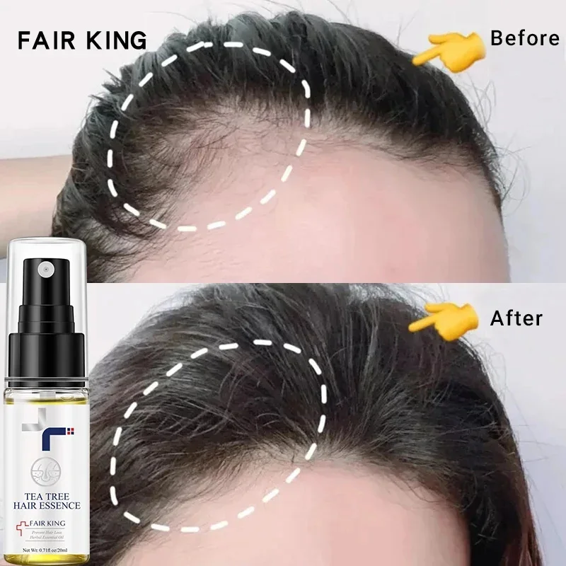 

Rapid Hair Growth Spray Scalp Treatment Anti-Hair Loss Essential Oil Prevention Baldness Repair Nourishing Hair Care Men Women
