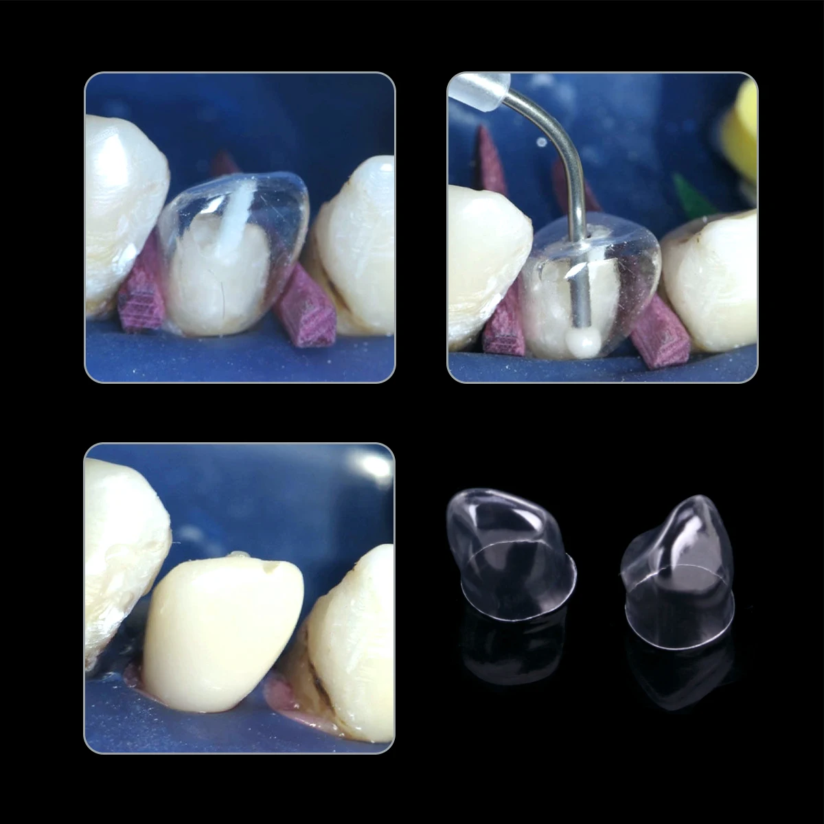 azdent dental anterior coroas transparentes dental temporária adulto suspensórios