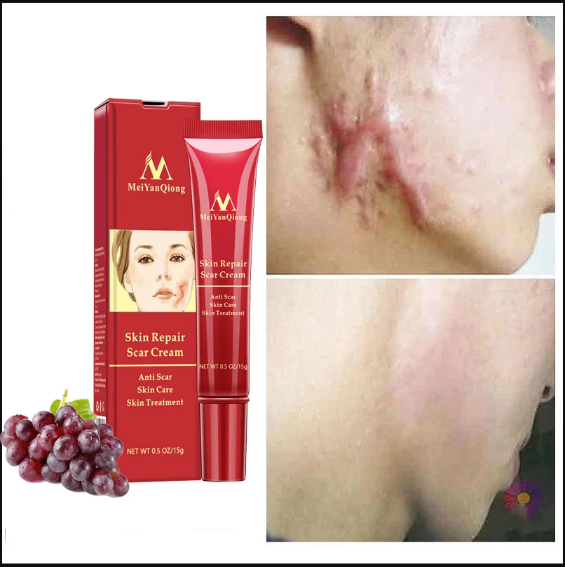 

Крем для удаления шрамов, средство для лечения растяжек, крем для хирургического восстановления шрамов, сглаживание и отбеливание кожи