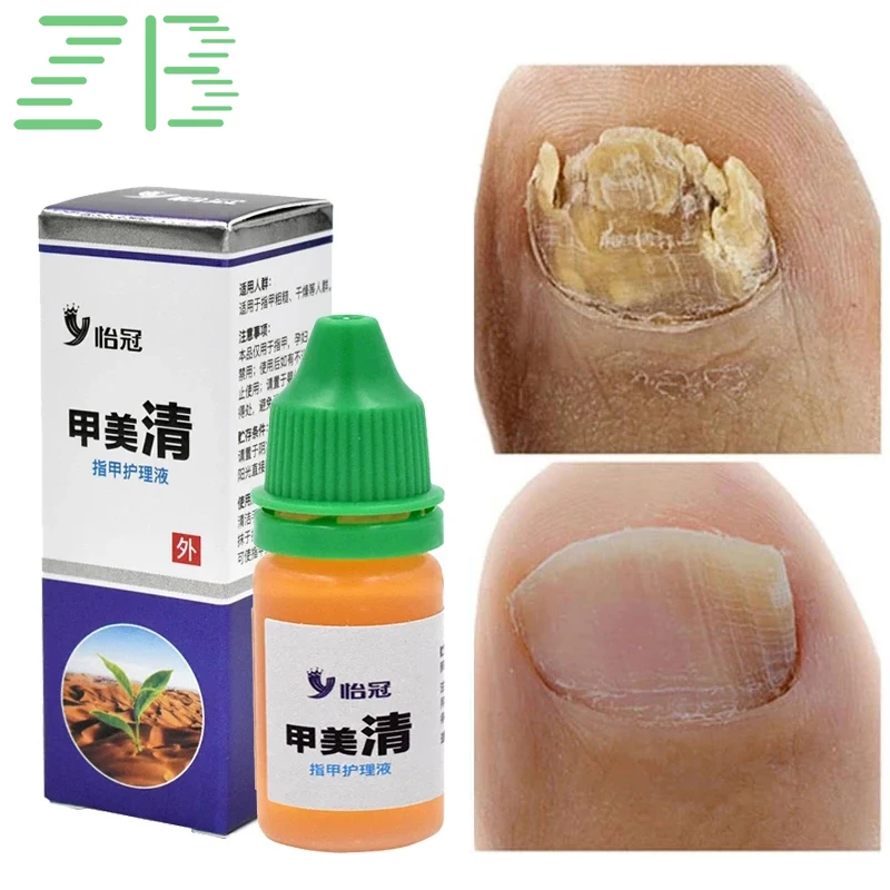 

5pcs/lot 10ml Nail Fungal Treatment Feet Care Essence Anti Infection Paronychia Onychomycosis Foot Toe Nail Fungus Removal Gel