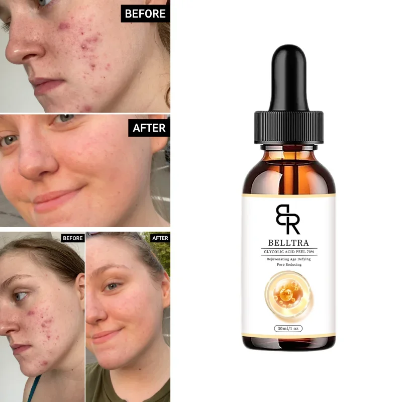 70% Glycolic Acid Chemical Peel Anti-Aging Brightening Smoothing Fine Lines Skin Pigmentation Acne Scars 30ml
