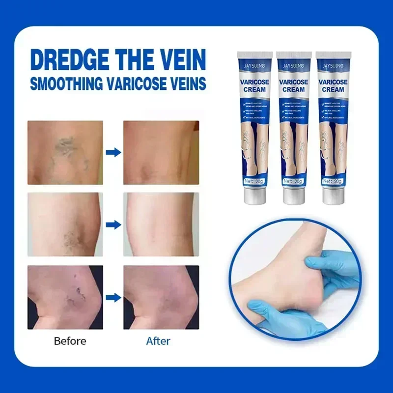 Varicose Vein Ointment Effective Relief Vasculitis Spider Legs Pain Treatment Care Essential